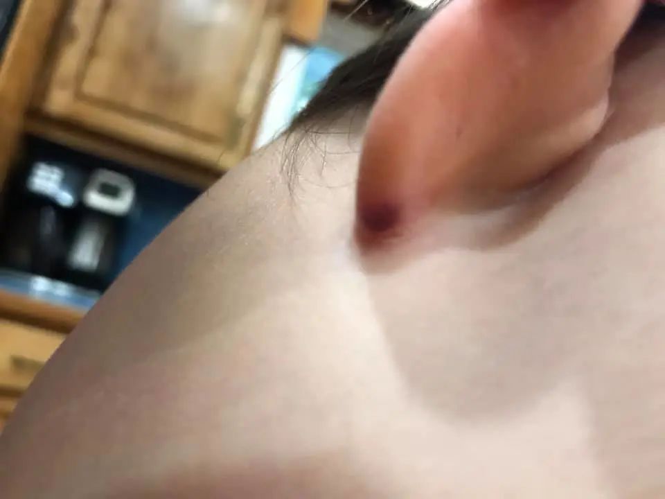 孩子被咬一口就全身麻痹瘫痪，这种吸血小虫又回归土狼屯！