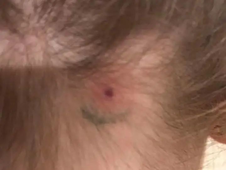 孩子被咬一口就全身麻痹瘫痪，这种吸血小虫又回归土狼屯！