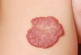 孩子的胎记都代表什么意思?这样的胎记要留意了! 孩子的胎记都代表什么意思?这样的胎记要留意了!