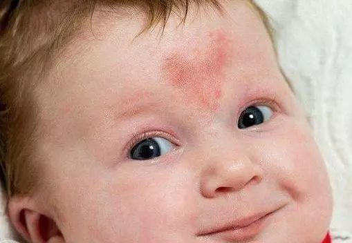 孩子的胎记都代表什么意思?这样的胎记要留意了! 孩子的胎记都代表什么意思?这样的胎记要留意了!