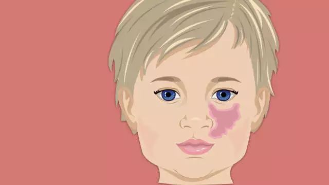 孩子的胎记都代表什么意思?这样的胎记要留意了! 孩子的胎记都代表什么意思?这样的胎记要留意了!