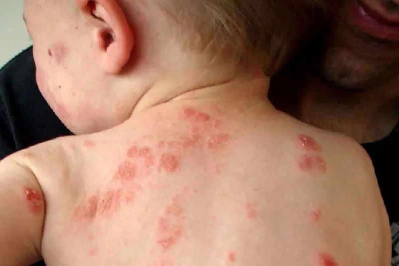 越痒越搔越痒,幼儿湿疹如何护理?到底哪款湿疹霜好用? 越痒越搔越痒,幼儿湿疹如何护理?到底哪款湿疹霜好用?