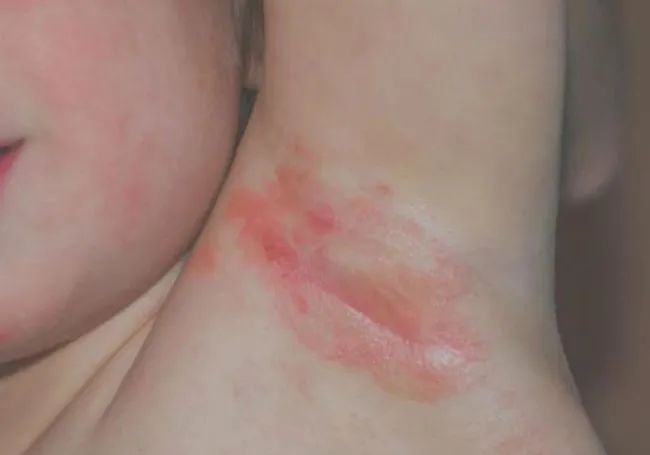 越痒越搔越痒，幼儿湿疹如何护理？到底哪款湿疹霜好用？