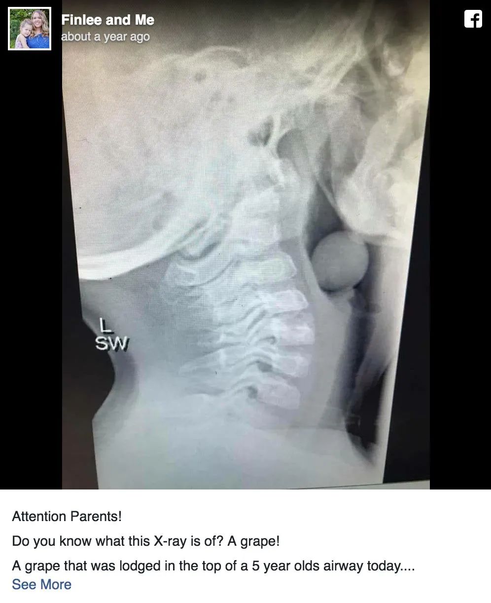 一颗葡萄差点要了孩子的命！午餐便当带圆形水果一定要这样切