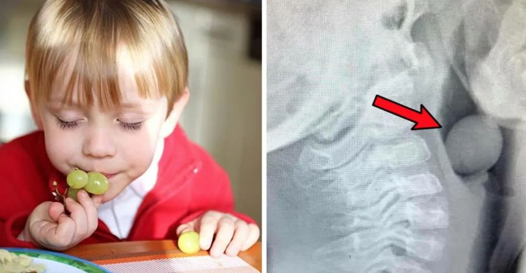 一颗葡萄差点要了孩子的命！午餐便当带圆形水果一定要这样切