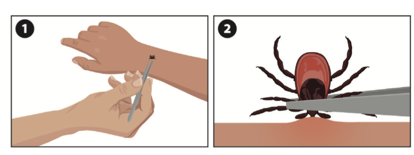 安省蜱虫爆发季：有孩子被咬差点瘫痪，咬后必须这么处理