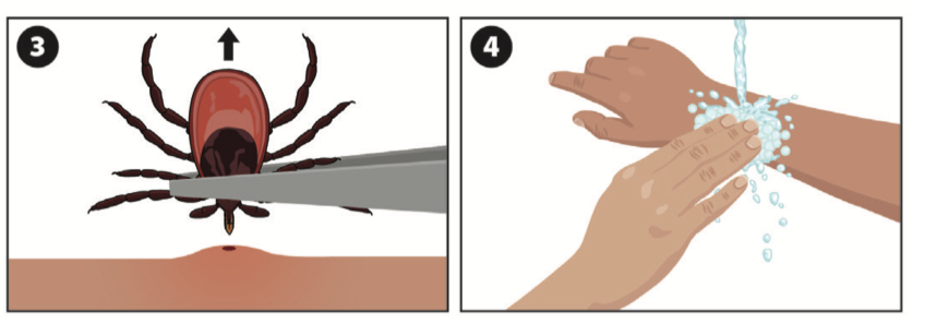 安省蜱虫爆发季：有孩子被咬差点瘫痪，咬后必须这么处理