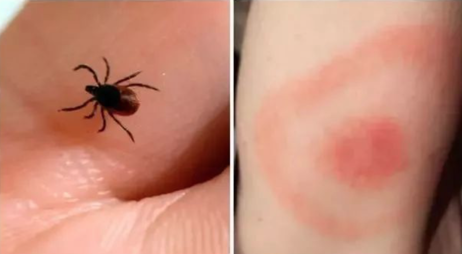 安省蜱虫爆发季：有孩子被咬差点瘫痪，咬后必须这么处理