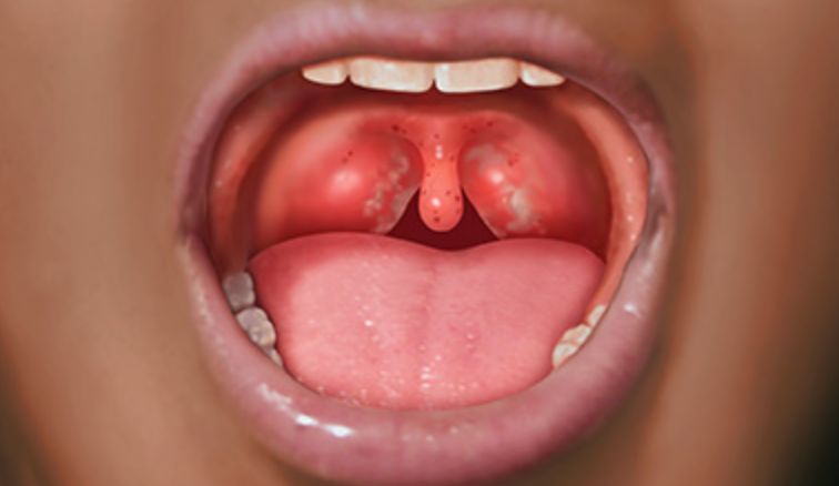 咳嗽+喉咙痛！又一个儿童群体高发病再次爆发：去年爆发期造成3名加拿大儿童死亡