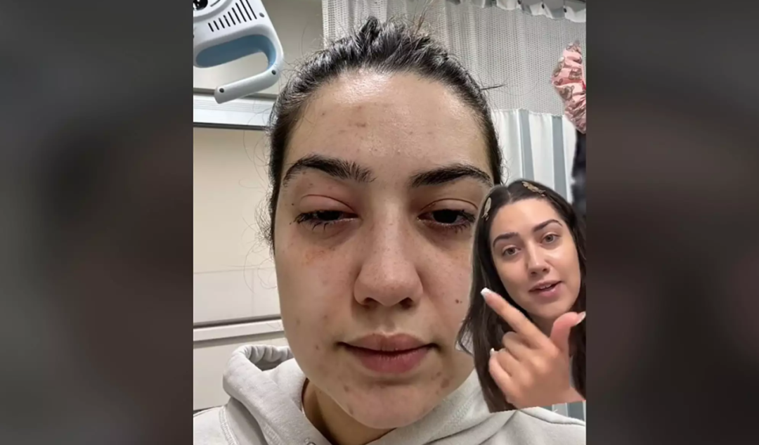 眼球红肿!多伦多女子在湖里游泳受感染进急诊!提醒:玩水前,先查查水质实时监控 眼球红肿!多伦多女子在湖里游泳受感染进急诊!提醒:玩水前,先查查水质实时监控