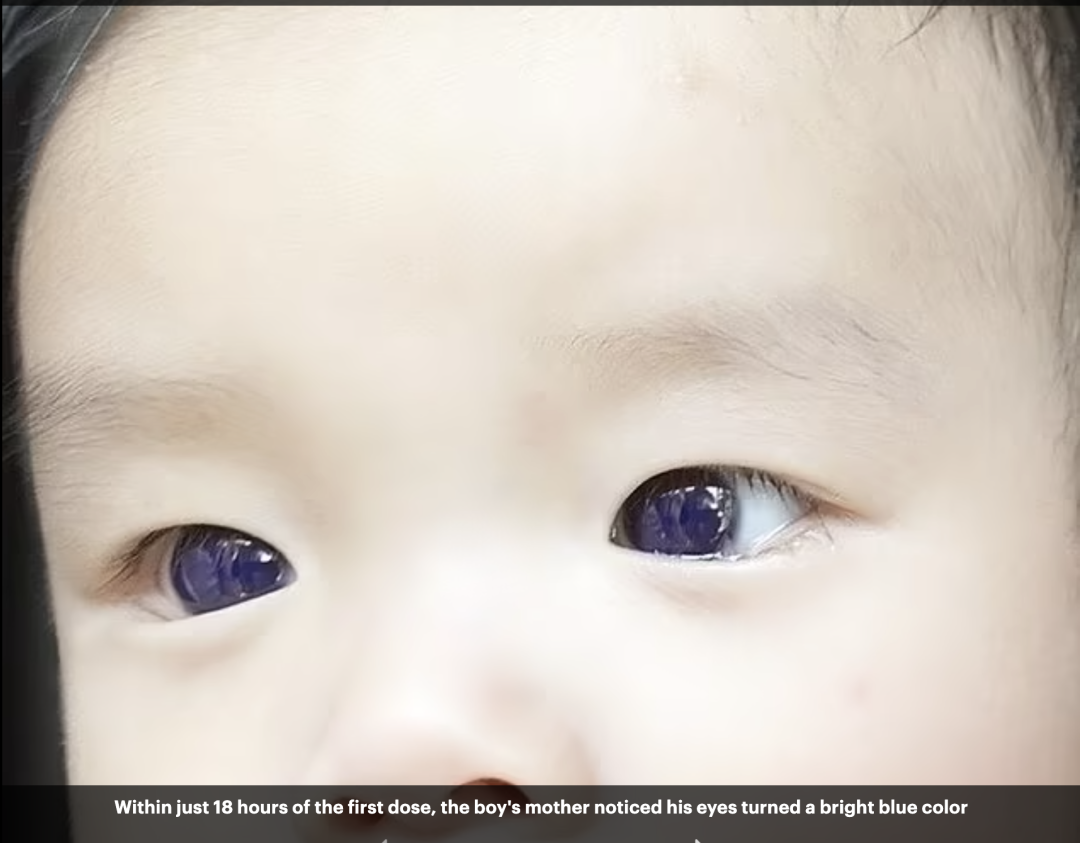 6个月大男孩服用儿童新冠特效药后，眼珠子从棕色变成了蓝色