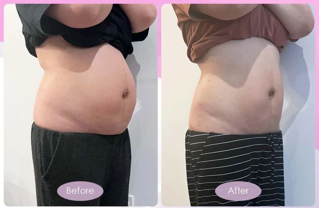 古法扎肚、骨盆修复有没有用？一组Before VS After 前后对比告诉她