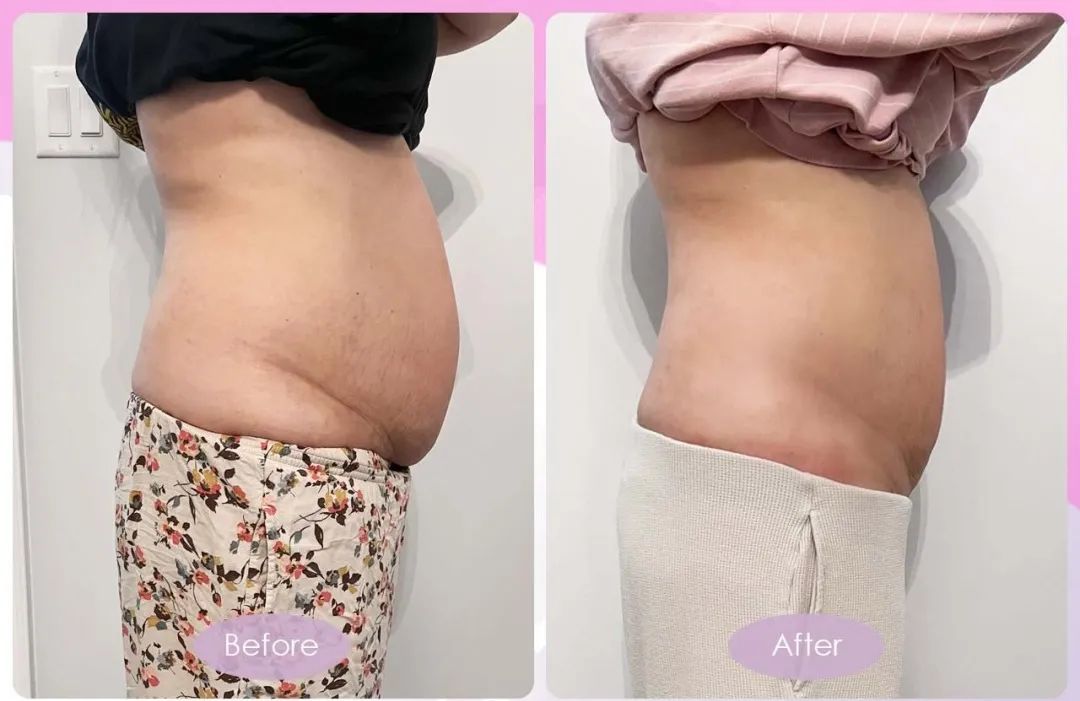 古法扎肚、骨盆修复有没有用？一组Before VS After 前后对比告诉她