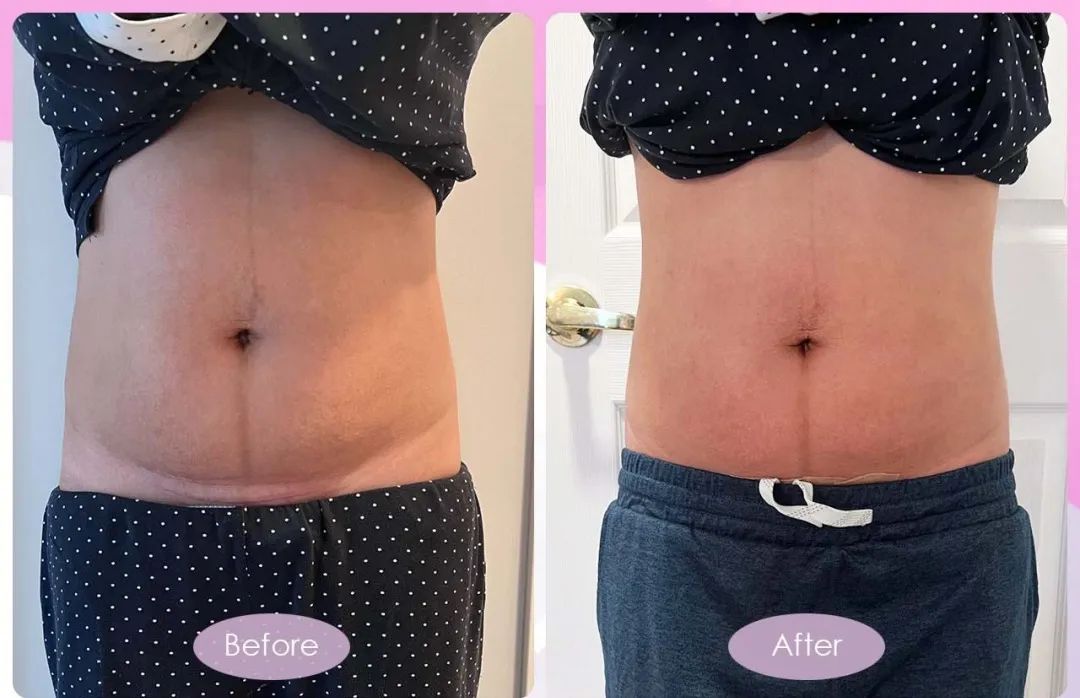 古法扎肚、骨盆修复有没有用？一组Before VS After 前后对比告诉她