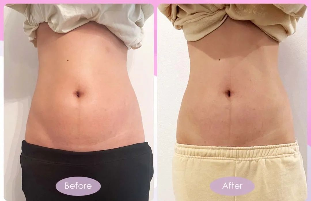 古法扎肚、骨盆修复有没有用？一组Before VS After 前后对比告诉她